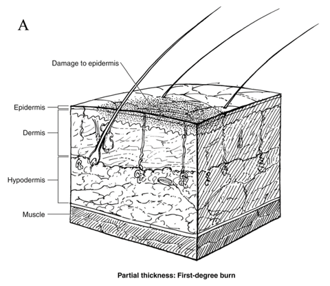 First-degree burn